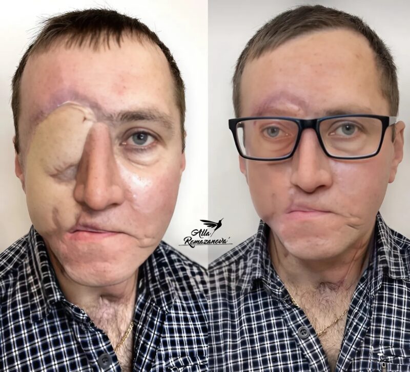 Diese Künstlerin tätowiert ein permanentes Auge auf das Gesicht eines Mannes, der nach einem tragischen Unfall entstellt wurde.