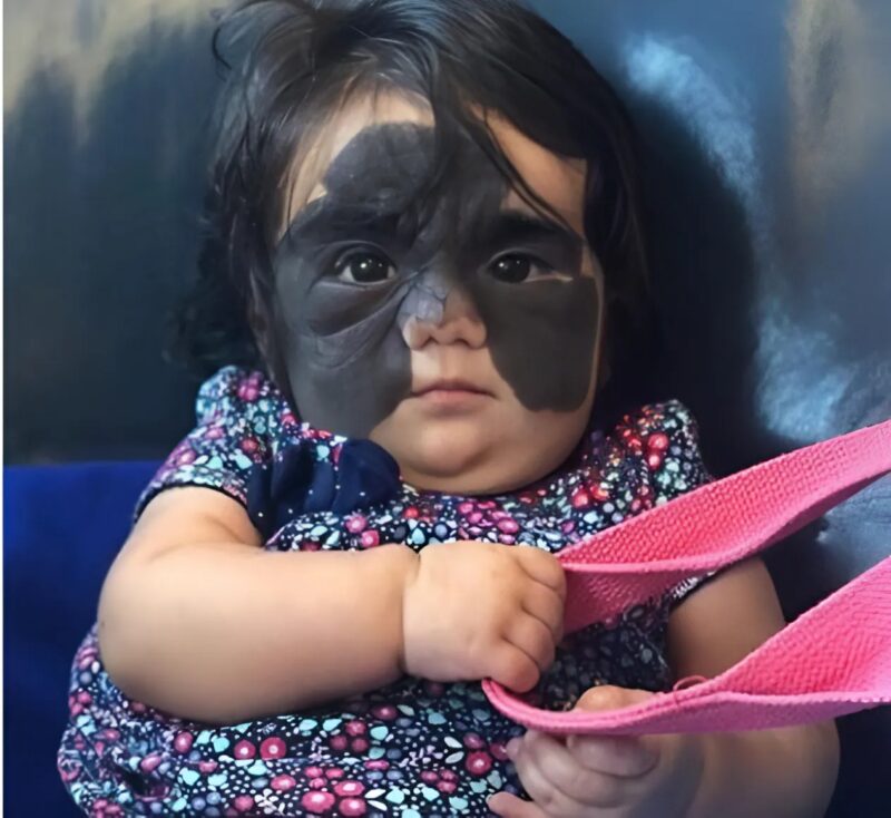 „Die Maske existiert nicht mehr: Die kleine Emma wurde dank einer innovativen Methode, die ihr Leben veränderte, auf wundersame Weise geheilt
