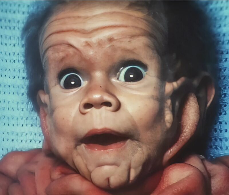 „Ein Baby mit einer seltenen Hautkrankheit gibt Ärzten von Geburt an Rätsel auf“